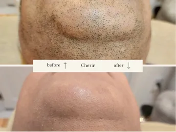 鳥取県倉吉市でヒゲ脱毛するならここ!脱毛サロンCherirシェリールで痛みを抑えて最短で清潔感を